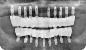 X-RAY 치료 후