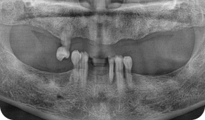 X-RAY 치료 전