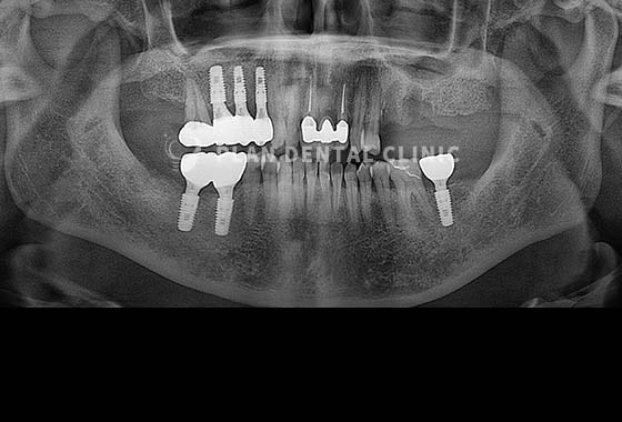X-RAY 치료 전