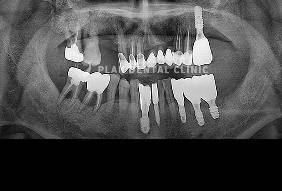 X-RAY 치료 전