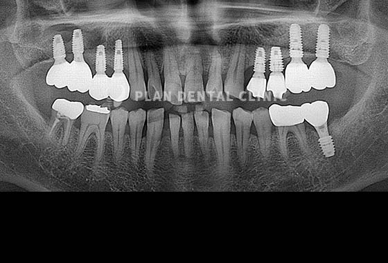 X-RAY 치료 전