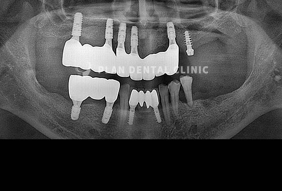 X-RAY 치료 전