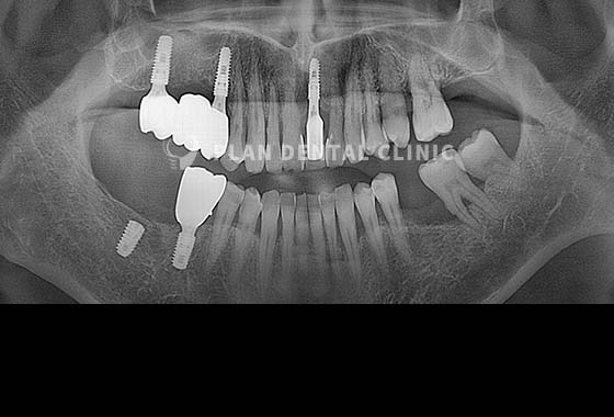 X-RAY 치료 전