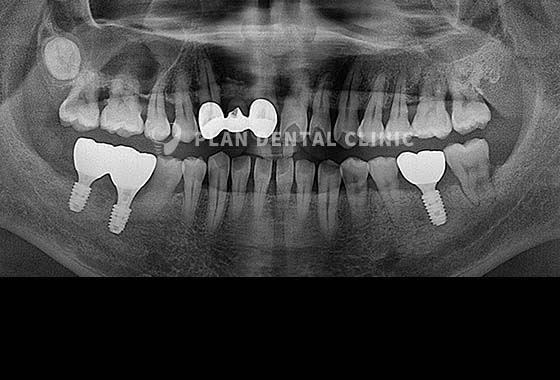 X-RAY 치료 전