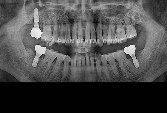 X-RAY 치료 전
