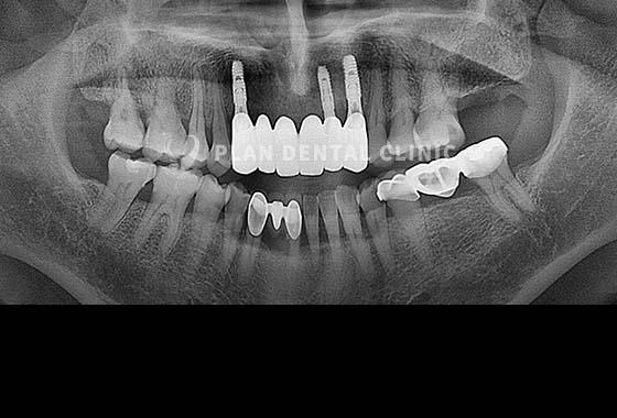 X-RAY 치료 전