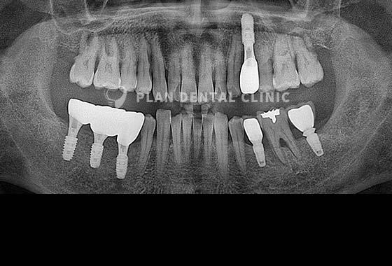 X-RAY 치료 전