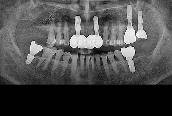 X-RAY 치료 전
