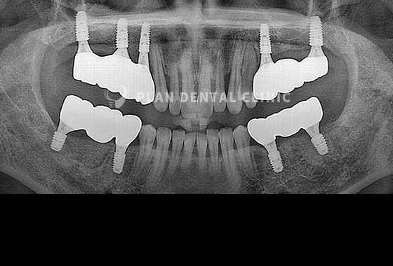 X-RAY 치료 전