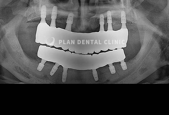X-RAY 치료 전