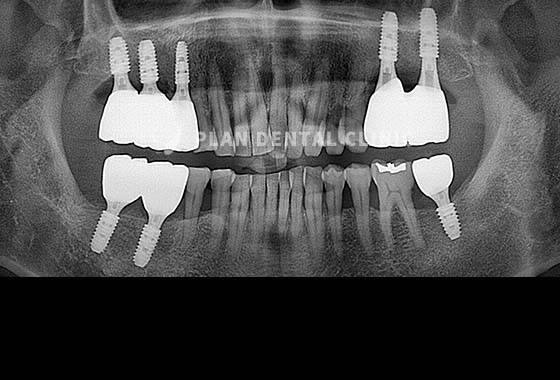X-RAY 치료 전
