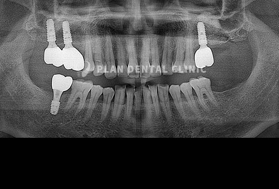 X-RAY 치료 전