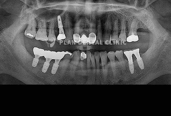 X-RAY 치료 전