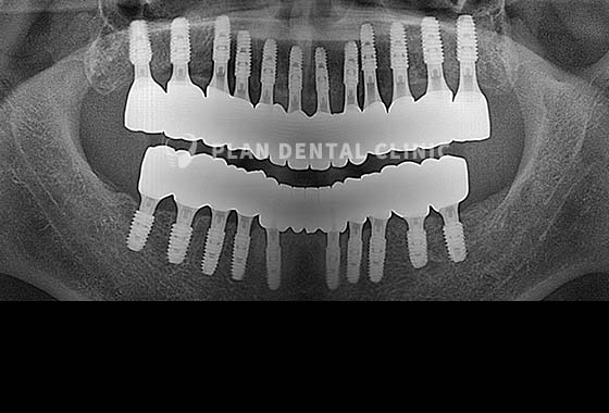 X-RAY 치료 전
