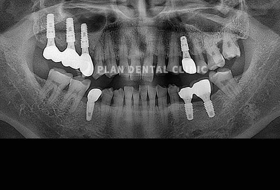 X-RAY 치료 전