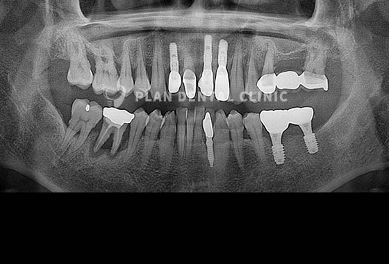 X-RAY 치료 전