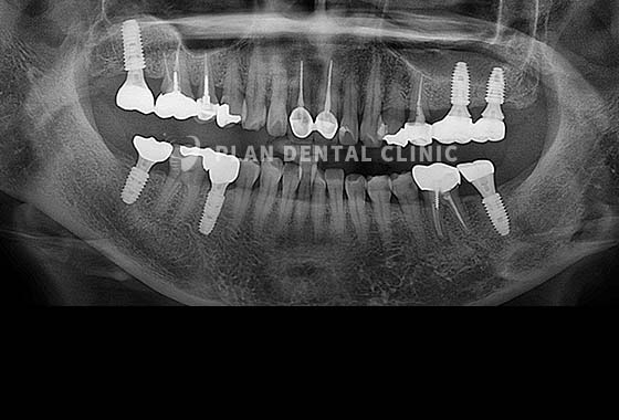 X-RAY 치료 전