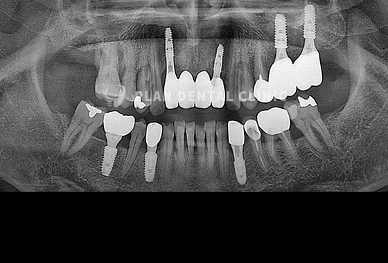 X-RAY 치료 전