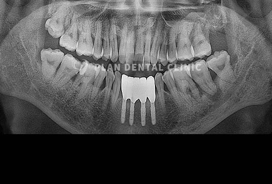 X-RAY 치료 전