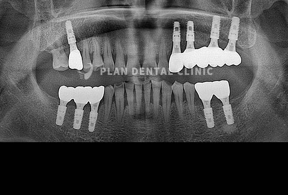 X-RAY 치료 전