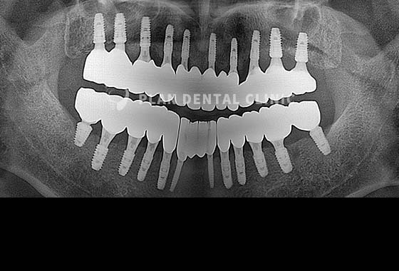 X-RAY 치료 전