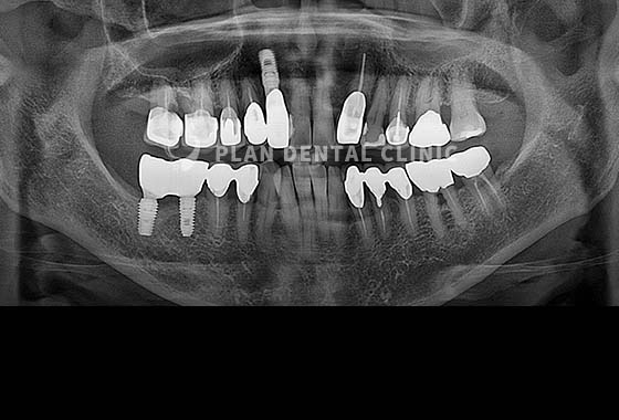 X-RAY 치료 전
