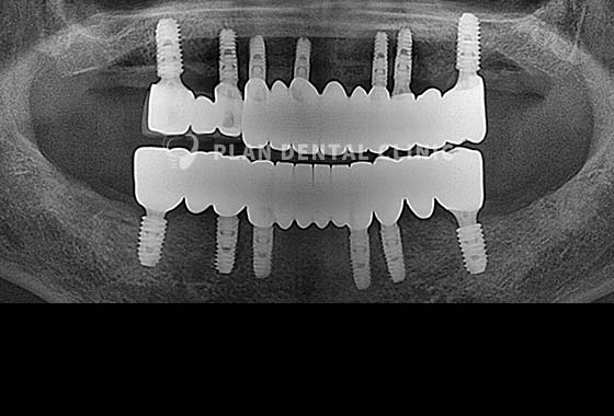 X-RAY 치료 전
