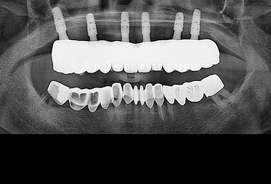 X-RAY 치료 전