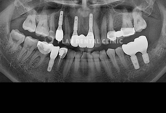 X-RAY 치료 전