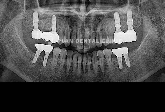 X-RAY 치료 전