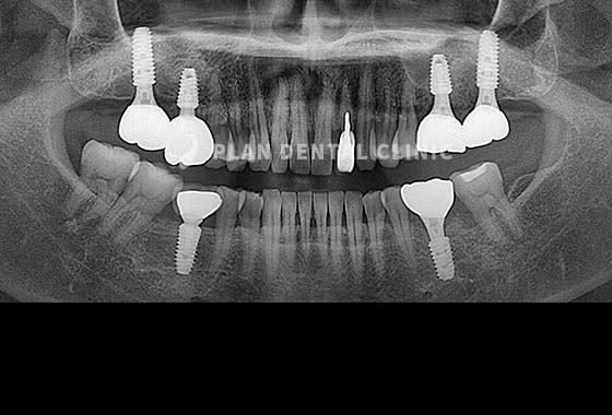 X-RAY 치료 전