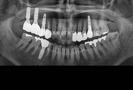 X-RAY 치료 전