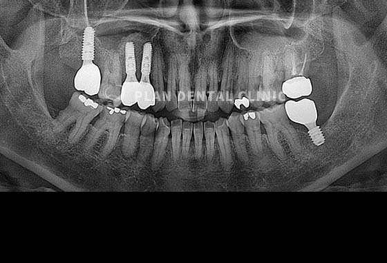 X-RAY 치료 전
