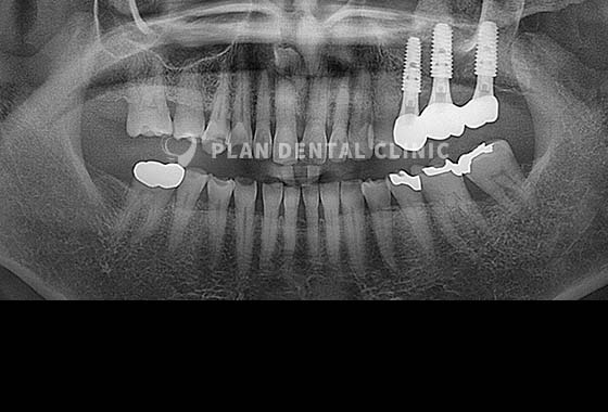 X-RAY 치료 전