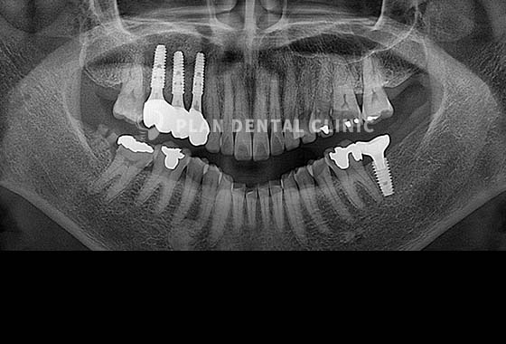 X-RAY 치료 전