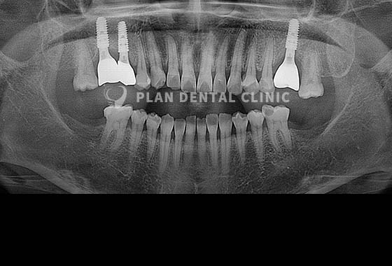 X-RAY 치료 전