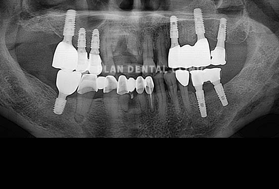 X-RAY 치료 전