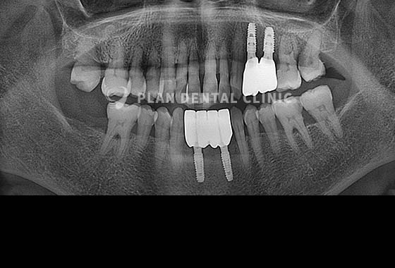 X-RAY 치료 전