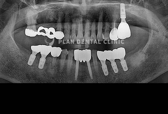 X-RAY 치료 전