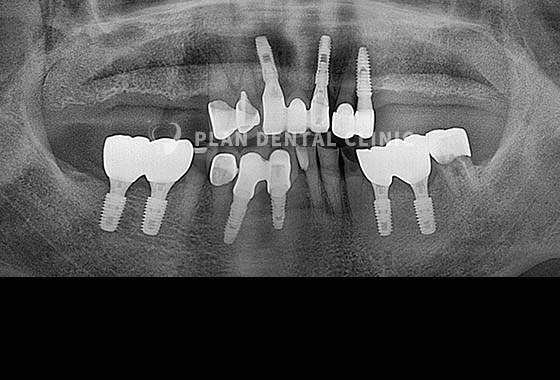X-RAY 치료 전