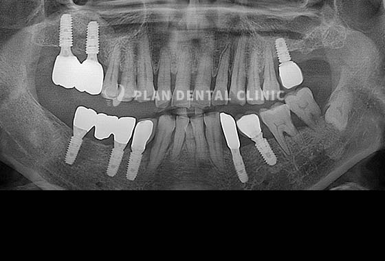 X-RAY 치료 전