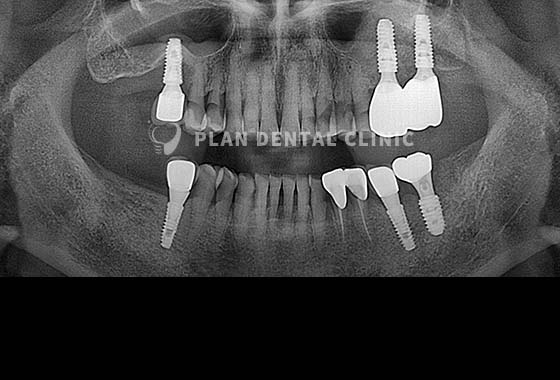 X-RAY 치료 전
