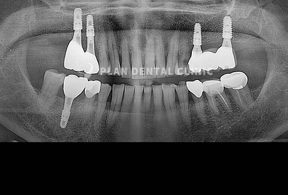X-RAY 치료 전