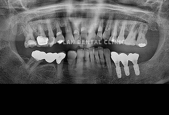 X-RAY 치료 전