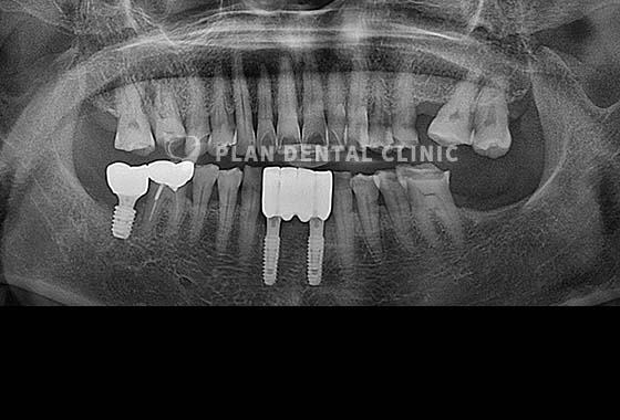 X-RAY 치료 전