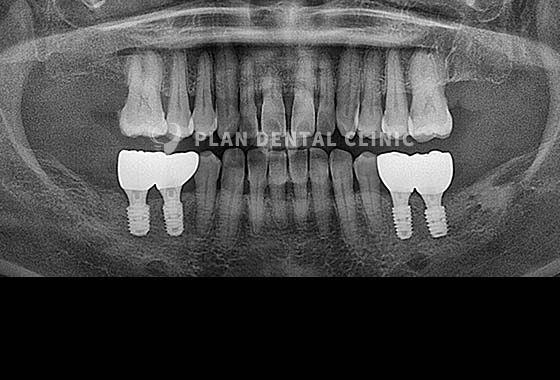 X-RAY 치료 전