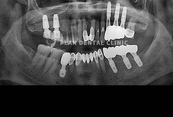 X-RAY 치료 전