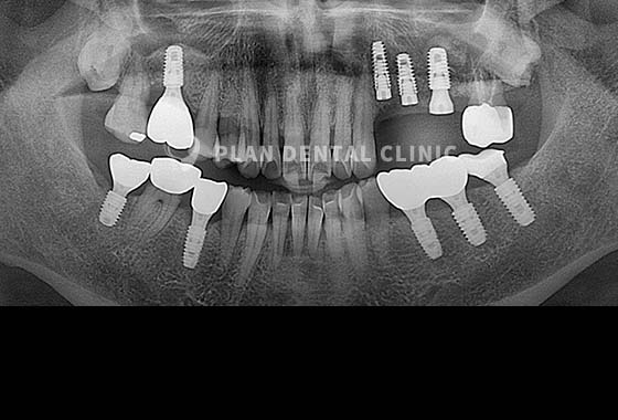 X-RAY 치료 전