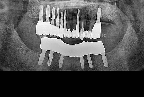 X-RAY 치료 전