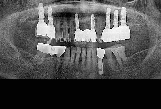 X-RAY 치료 전